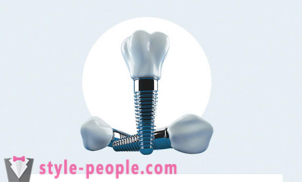 8 otázek o dentální implantáty