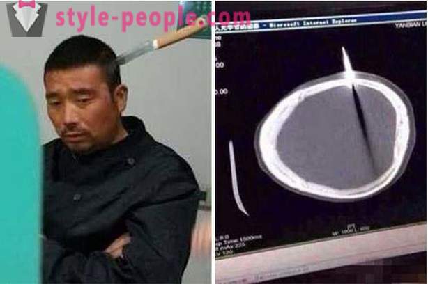 Číňan s nožem v hlavě šel k lékaři