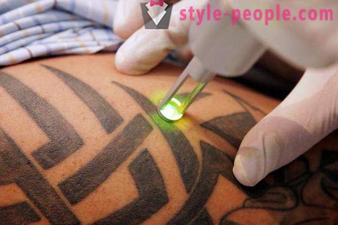 Laserové odstranění tetování. přezkoumala