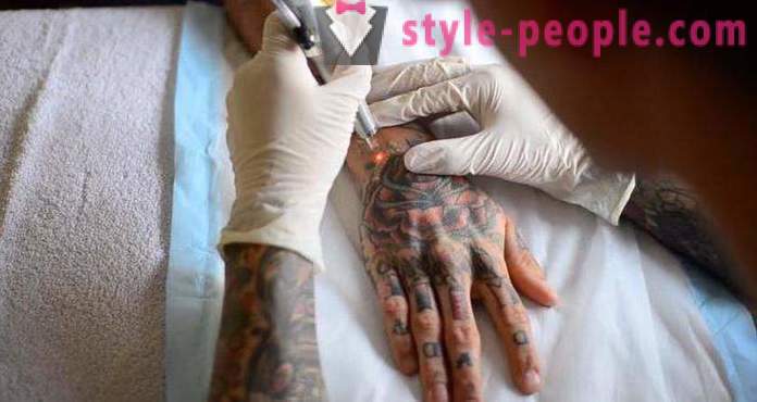 Laserové odstranění tetování. přezkoumala