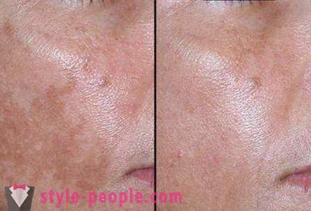 Peeling obličeje chlorid vápenatý: recenze