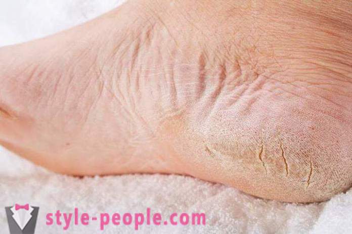 Suchá kůže na nohou: Příčiny