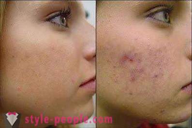 Chcete vědět, jak odstranit stopy po akné na obličeji?