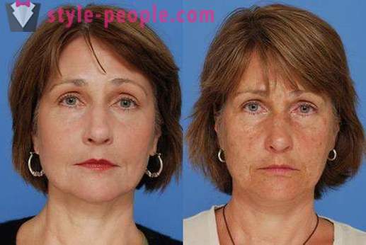 Laser resurfacing obličeje - bezpečný způsob, jak omladit