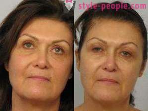 Laser resurfacing obličeje - bezpečný způsob, jak omladit