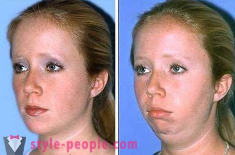 Jak odstranit tváře bez chirurgického zákroku